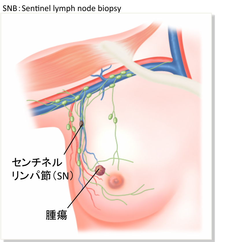 センチネルリンパ生検