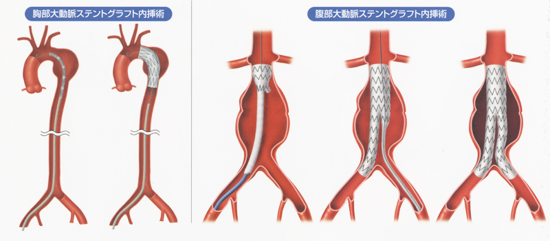 ステントグラフト内挿術