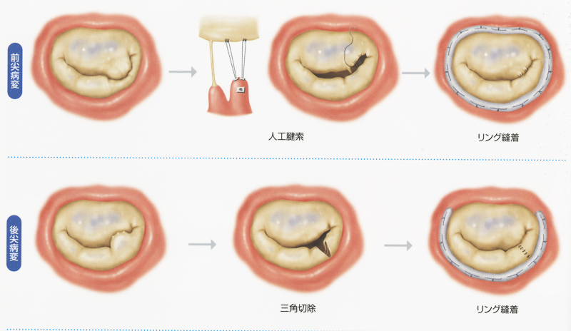 僧帽弁形成術